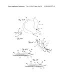 EMBOLIC PROTECTION DEVICES HAVING RADIOPAQUE ELEMENTS diagram and image