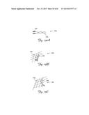 EMBOLIC PROTECTION DEVICES HAVING RADIOPAQUE ELEMENTS diagram and image