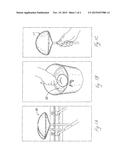 TEXTURED BREAST IMPLANT AND METHODS OF MAKING SAME diagram and image
