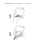 SOFT FILLED PROSTHESIS SHELL WITH VARIABLE TEXTURE diagram and image