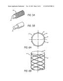 MINIMALLY INVASIVE TISSUE SUPPORT diagram and image