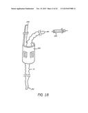 MINIMALLY INVASIVE TISSUE SUPPORT diagram and image