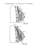 MINIMALLY INVASIVE TISSUE SUPPORT diagram and image