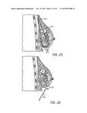 MINIMALLY INVASIVE TISSUE SUPPORT diagram and image