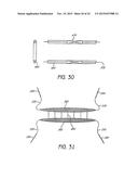 MINIMALLY INVASIVE TISSUE SUPPORT diagram and image