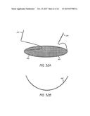 MINIMALLY INVASIVE TISSUE SUPPORT diagram and image