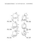 MINIMALLY INVASIVE TISSUE SUPPORT diagram and image