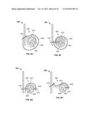 TRANSCATHETER VALVE WITH PARAVALVULAR LEAK SEALING RING diagram and image