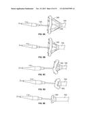 TRANSCATHETER VALVE WITH PARAVALVULAR LEAK SEALING RING diagram and image