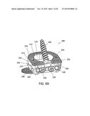 Standalone Interbody Implants diagram and image