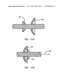 Endoprostheses and methods of manufacture diagram and image