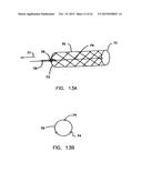 Endoprostheses and methods of manufacture diagram and image