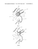 DEVICE AND METHOD FOR INCREASING FLOW THROUGH THE LEFT ATRIAL APPENDAGE diagram and image