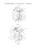 DEVICE AND METHOD FOR INCREASING FLOW THROUGH THE LEFT ATRIAL APPENDAGE diagram and image