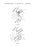 DEVICE AND METHOD FOR INCREASING FLOW THROUGH THE LEFT ATRIAL APPENDAGE diagram and image