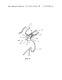 DEVICE AND METHOD FOR INCREASING FLOW THROUGH THE LEFT ATRIAL APPENDAGE diagram and image