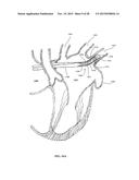 DEVICE AND METHOD FOR INCREASING FLOW THROUGH THE LEFT ATRIAL APPENDAGE diagram and image