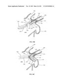 DEVICE AND METHOD FOR INCREASING FLOW THROUGH THE LEFT ATRIAL APPENDAGE diagram and image