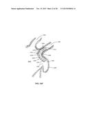 DEVICE AND METHOD FOR INCREASING FLOW THROUGH THE LEFT ATRIAL APPENDAGE diagram and image