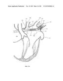 DEVICE AND METHOD FOR INCREASING FLOW THROUGH THE LEFT ATRIAL APPENDAGE diagram and image