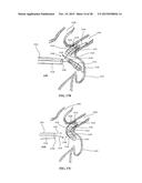 DEVICE AND METHOD FOR INCREASING FLOW THROUGH THE LEFT ATRIAL APPENDAGE diagram and image