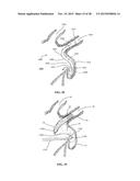 DEVICE AND METHOD FOR INCREASING FLOW THROUGH THE LEFT ATRIAL APPENDAGE diagram and image