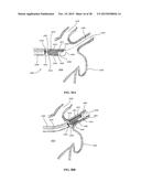 DEVICE AND METHOD FOR INCREASING FLOW THROUGH THE LEFT ATRIAL APPENDAGE diagram and image