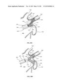 DEVICE AND METHOD FOR INCREASING FLOW THROUGH THE LEFT ATRIAL APPENDAGE diagram and image