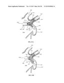 DEVICE AND METHOD FOR INCREASING FLOW THROUGH THE LEFT ATRIAL APPENDAGE diagram and image