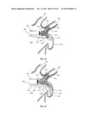 DEVICE AND METHOD FOR INCREASING FLOW THROUGH THE LEFT ATRIAL APPENDAGE diagram and image