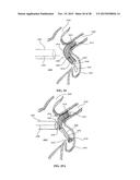 DEVICE AND METHOD FOR INCREASING FLOW THROUGH THE LEFT ATRIAL APPENDAGE diagram and image