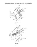 DEVICE AND METHOD FOR INCREASING FLOW THROUGH THE LEFT ATRIAL APPENDAGE diagram and image