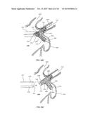 DEVICE AND METHOD FOR INCREASING FLOW THROUGH THE LEFT ATRIAL APPENDAGE diagram and image