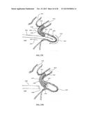 DEVICE AND METHOD FOR INCREASING FLOW THROUGH THE LEFT ATRIAL APPENDAGE diagram and image