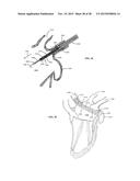 DEVICE AND METHOD FOR INCREASING FLOW THROUGH THE LEFT ATRIAL APPENDAGE diagram and image