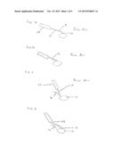 Cataract Removal Tool diagram and image