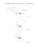 Cataract Removal Tool diagram and image