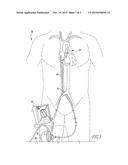 Pumping System and Method for Assisting a Patient s Heart diagram and image