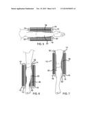 Limb Irrigation Pan Device diagram and image