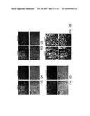 Identification of a 5-Gene Expression Signature Predicting Clinical     Outcome of Patients with Brain Tumors diagram and image