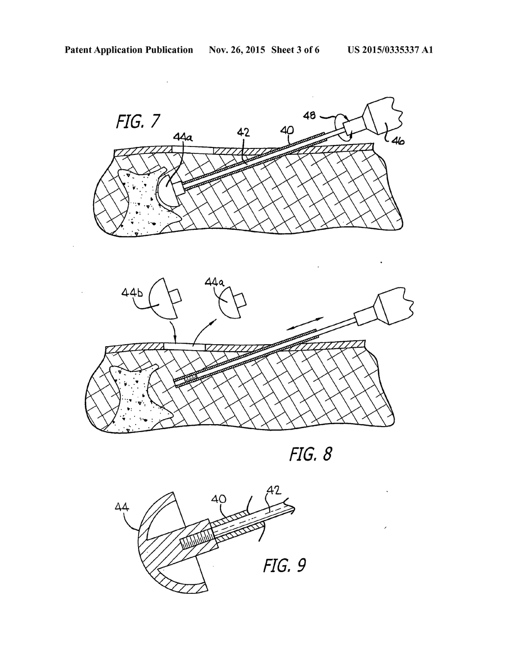 Apparatus for and method of providing a hip replacement - diagram, schematic, and image 04