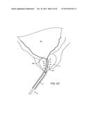 TISSUE RESECTION AND TREATMENT WITH SHEDDING PULSES diagram and image