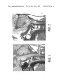 CRANIOSPINAL FUSION METHOD AND APPARATUS diagram and image