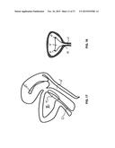 Methods And Devices For Treating Pelvic Conditions diagram and image