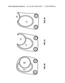 Methods And Devices For Treating Pelvic Conditions diagram and image