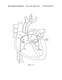 APPARATUS FOR SAFE PERFORMANCE OF TRANSSEPTAL TECHNIQUE AND PLACEMENT AND     POSITIONING OF AN ABLATION CATHETER diagram and image