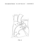 APPARATUS FOR SAFE PERFORMANCE OF TRANSSEPTAL TECHNIQUE AND PLACEMENT AND     POSITIONING OF AN ABLATION CATHETER diagram and image