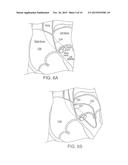 APPARATUS FOR SAFE PERFORMANCE OF TRANSSEPTAL TECHNIQUE AND PLACEMENT AND     POSITIONING OF AN ABLATION CATHETER diagram and image