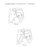 APPARATUS FOR SAFE PERFORMANCE OF TRANSSEPTAL TECHNIQUE AND PLACEMENT AND     POSITIONING OF AN ABLATION CATHETER diagram and image