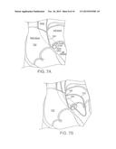 APPARATUS FOR SAFE PERFORMANCE OF TRANSSEPTAL TECHNIQUE AND PLACEMENT AND     POSITIONING OF AN ABLATION CATHETER diagram and image